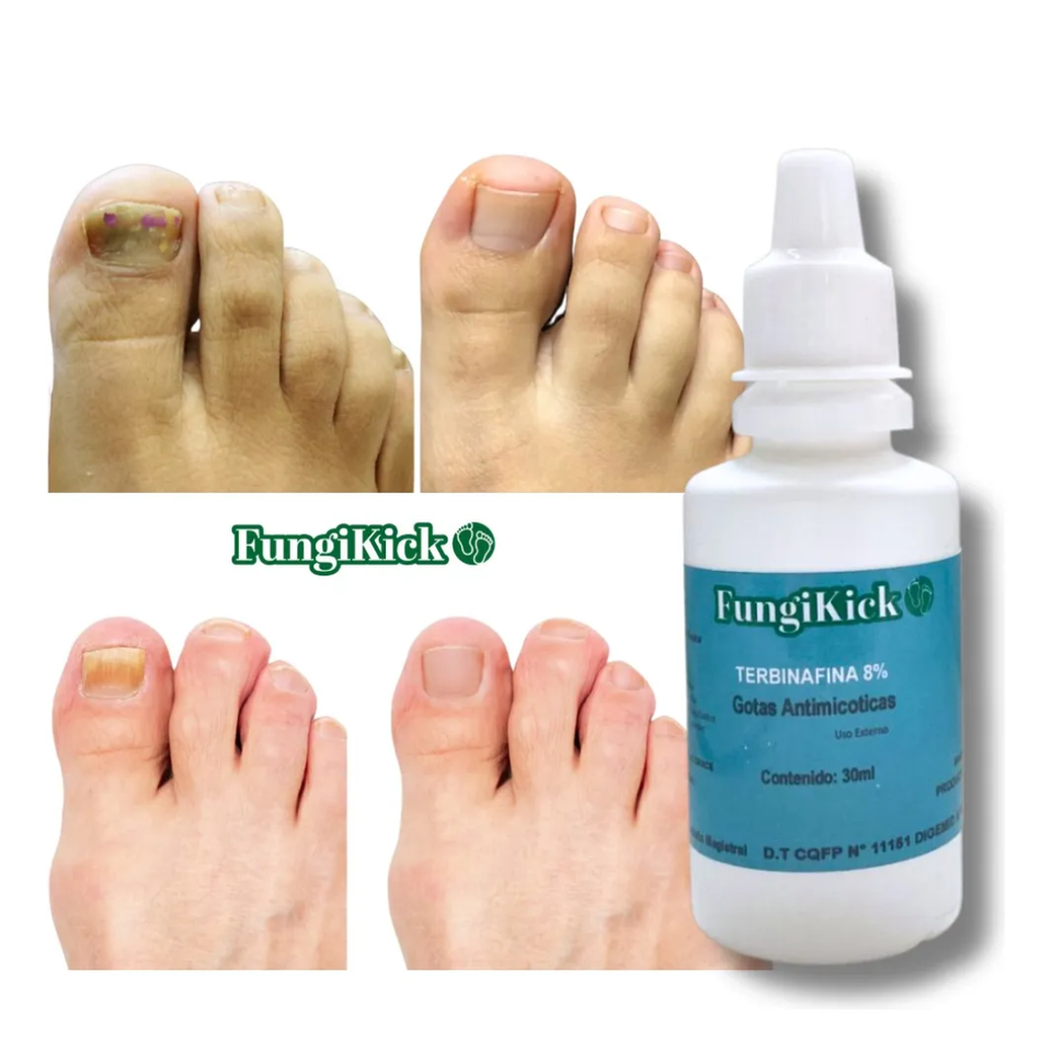 GOTAS CONTRA HONGOS DE LAS UÑAS